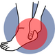 Plantar Fasciitis